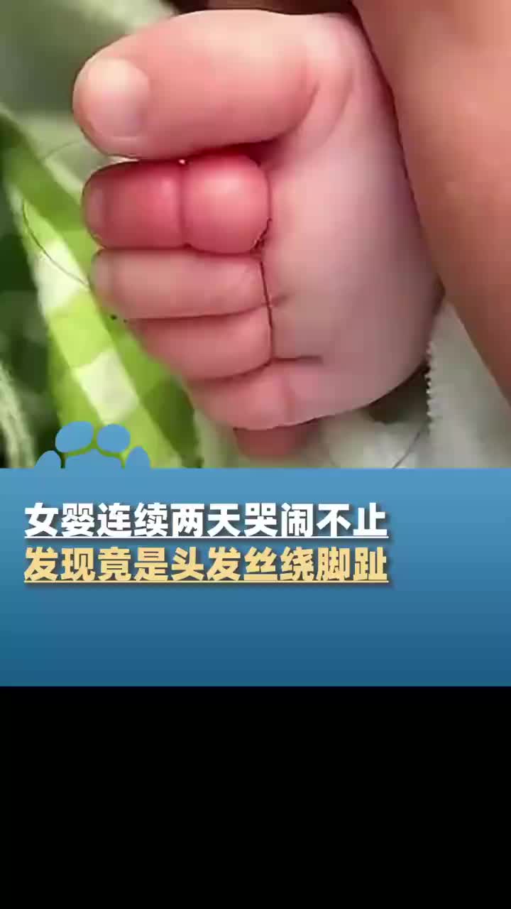 女婴两天哭闹不止竟因头发丝绕脚趾